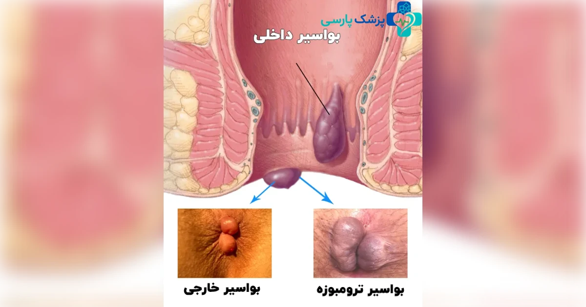 انواع بواسیر و درمان