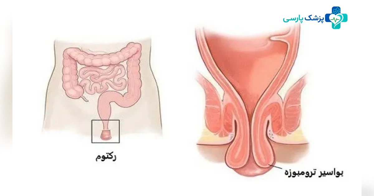 علت بواسیر در زنان چیست