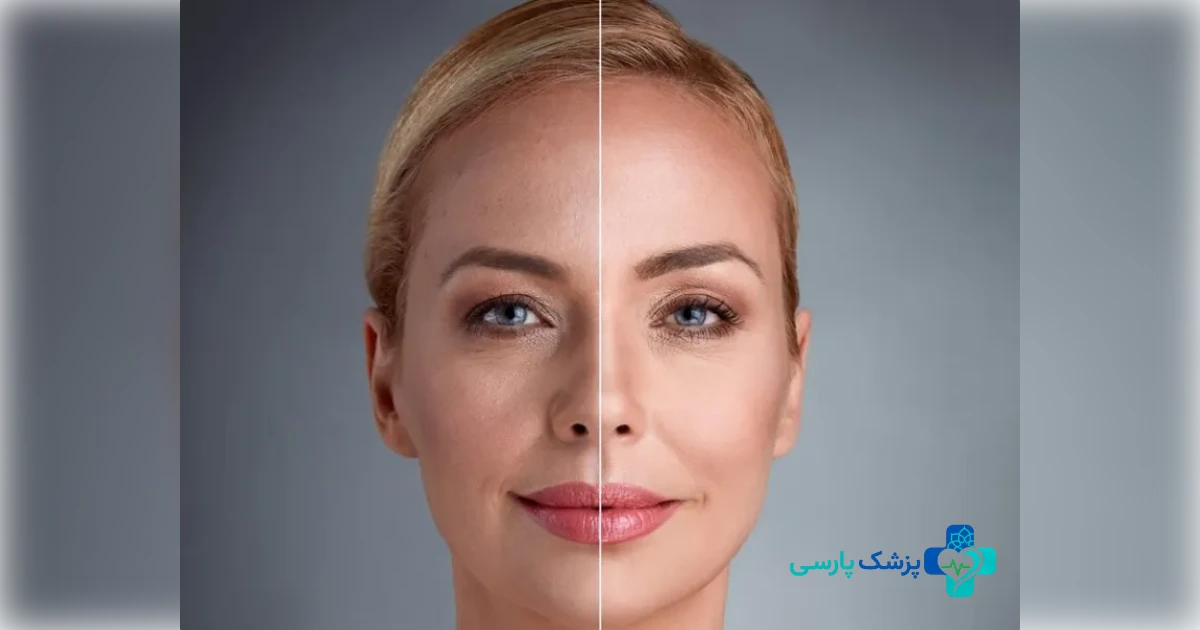 تفاوت وایتلیفت با هایفو