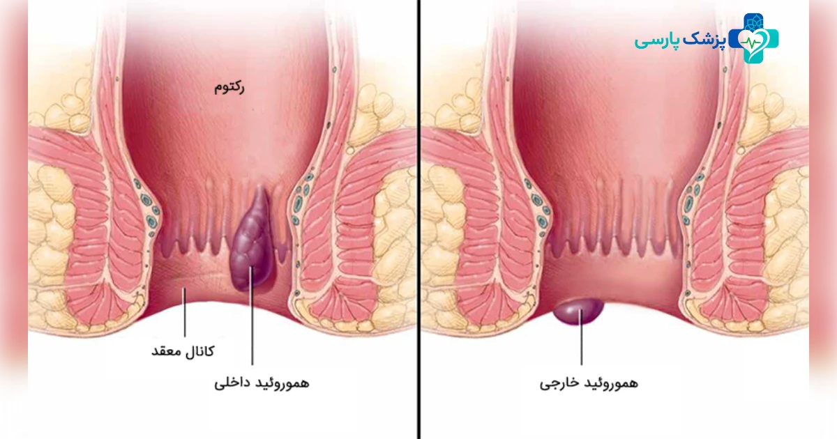 بواسیر داخلیو خارجی