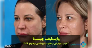 وایت‌ لیفت چیست