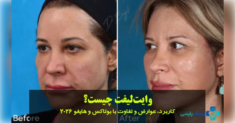 وایت‌ لیفت چیست