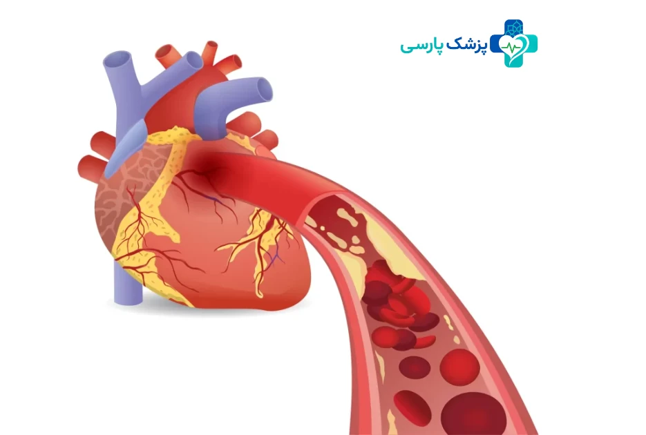 بیماری عروق کرونر قلب - خطرناک ترین بیماری قلبی