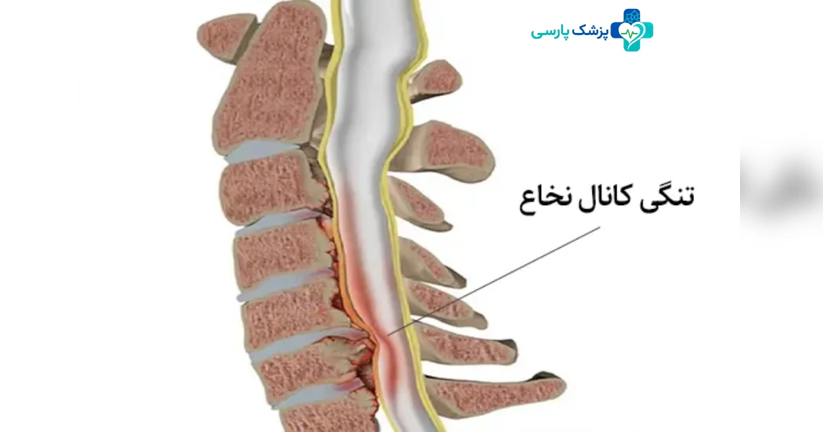 تنگی کانال نخاع گردن چیست