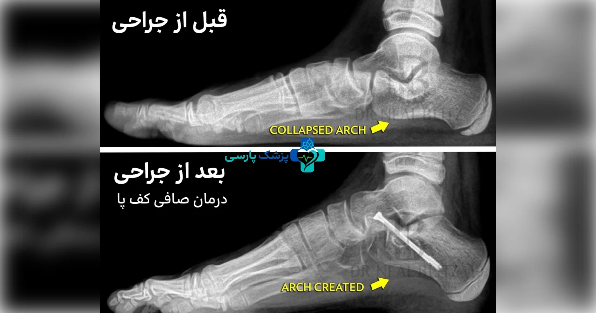 عمل کف پای صاف چه زمانی توصیه میشود