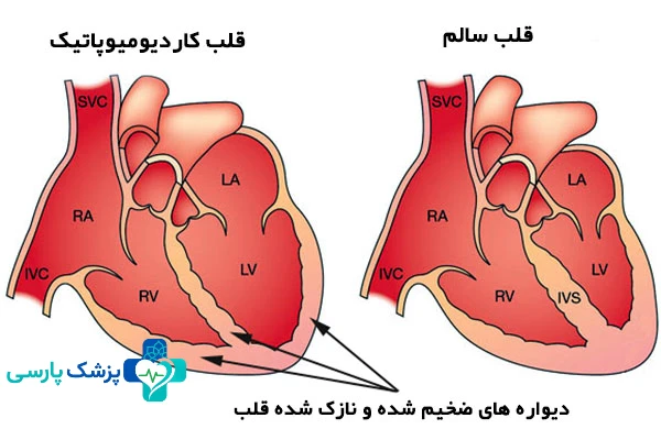 خطرناکترین بیماری قلبی - کاردیومیوپاتی (بیماری عضله قلب)